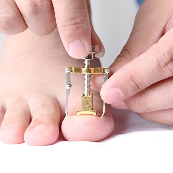 Toenail Machine Precision Comfort - Professional Ingrown Toenail Lifter and | Inspire ...