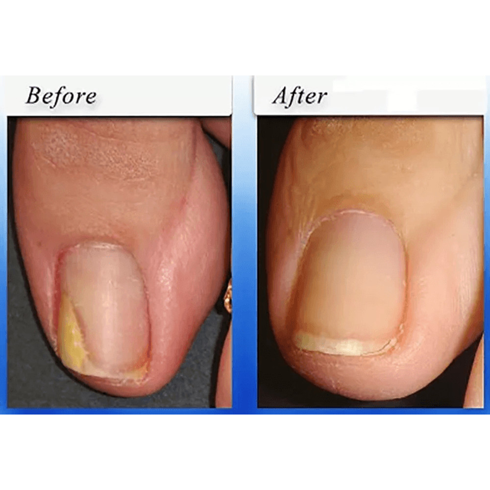 Natural Nail Fungus Treatment Effective Solution For Toe Finger Nail Infections 3