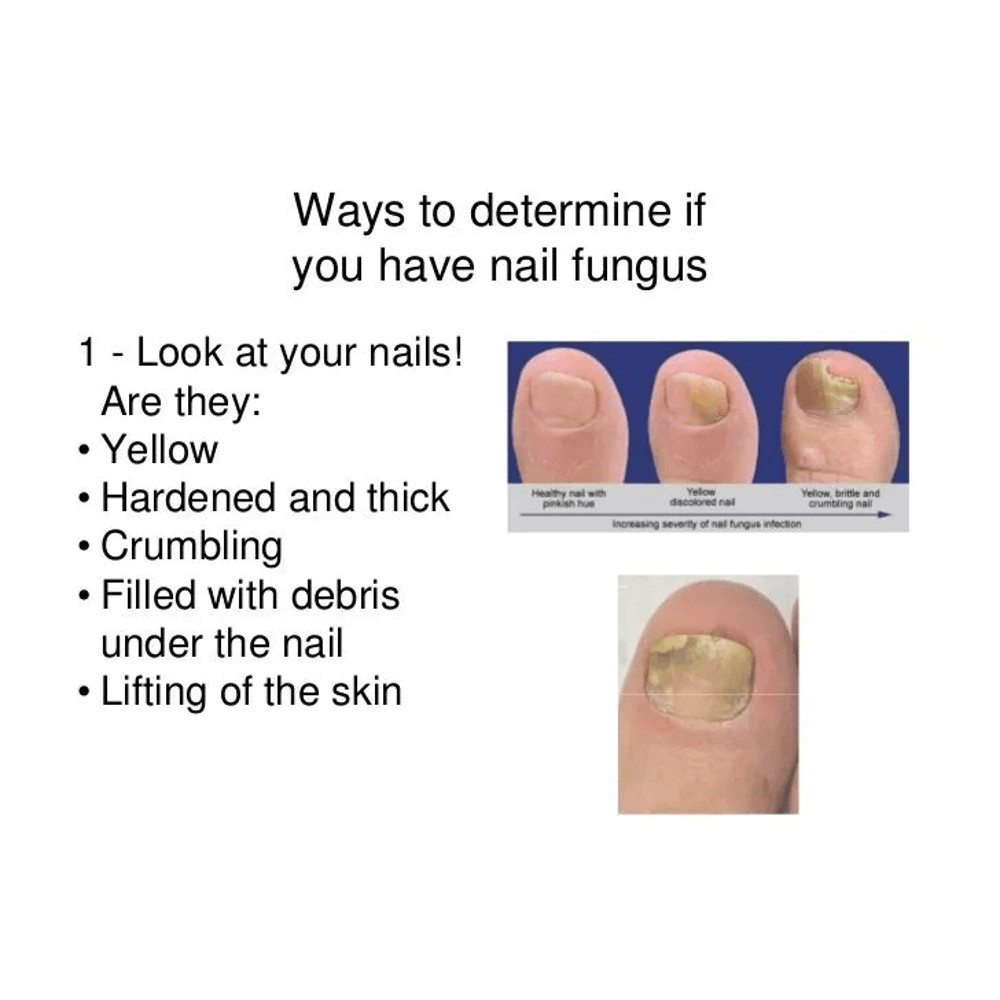 Natural Nail Fungus Treatment Effective Solution For Toe Finger Nail Infections 1