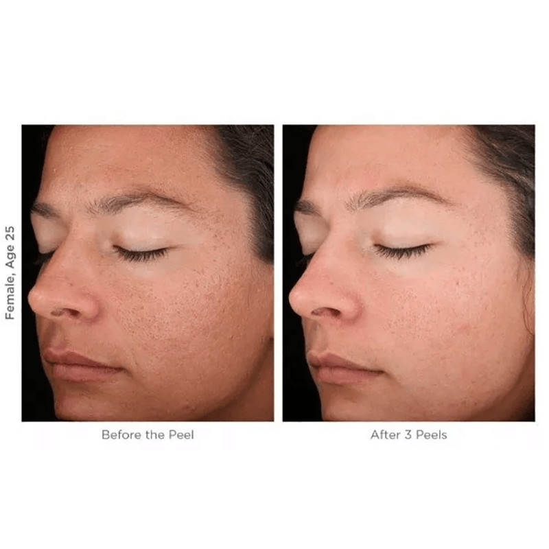 MicroDermabrasion AHA Cream Exfoliant Anti Aging Anti Wrinkle Resurfacing Scrub With Organic Ingred 1