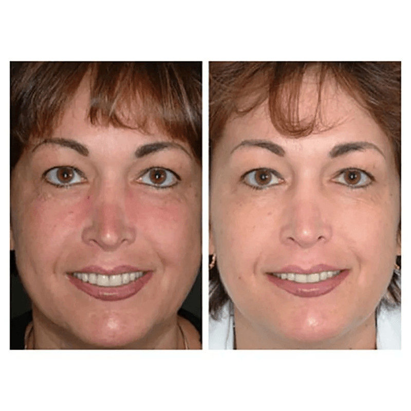 MicroDermabrasion AHA Cream Exfoliant Anti Aging Anti Wrinkle Resurfacing Scrub With Organic Ingred 4