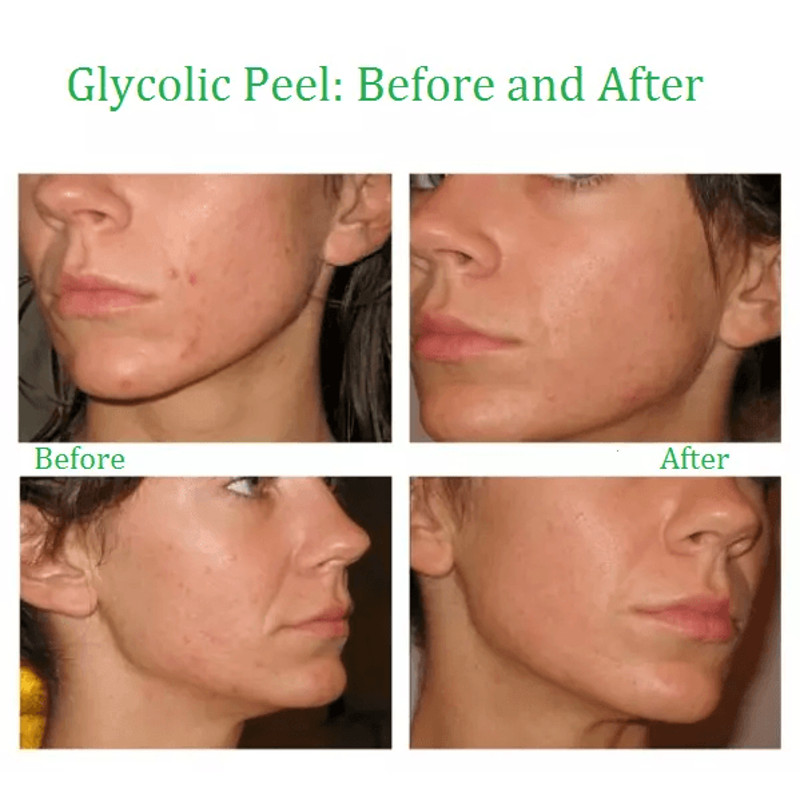 Advanced Glycolic Acid Plus AntiAging Serum Cream Fades Acne Scars Wrinkles  Dark Spots For Youthfu 2