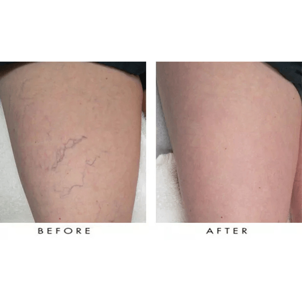 Vitamin K Cream Maximum Strength Skin Repair Spider Vein Varicose Vein Bruise Treatment For All Ski 6