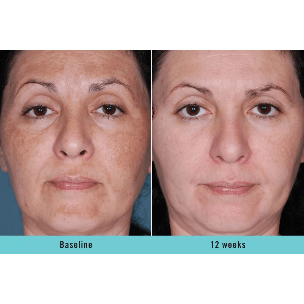 KOJIC ACID Skin Whitening Face Brightening Serum Dark Spot Remover With Alpha ArbutinVitamin C Mela 3