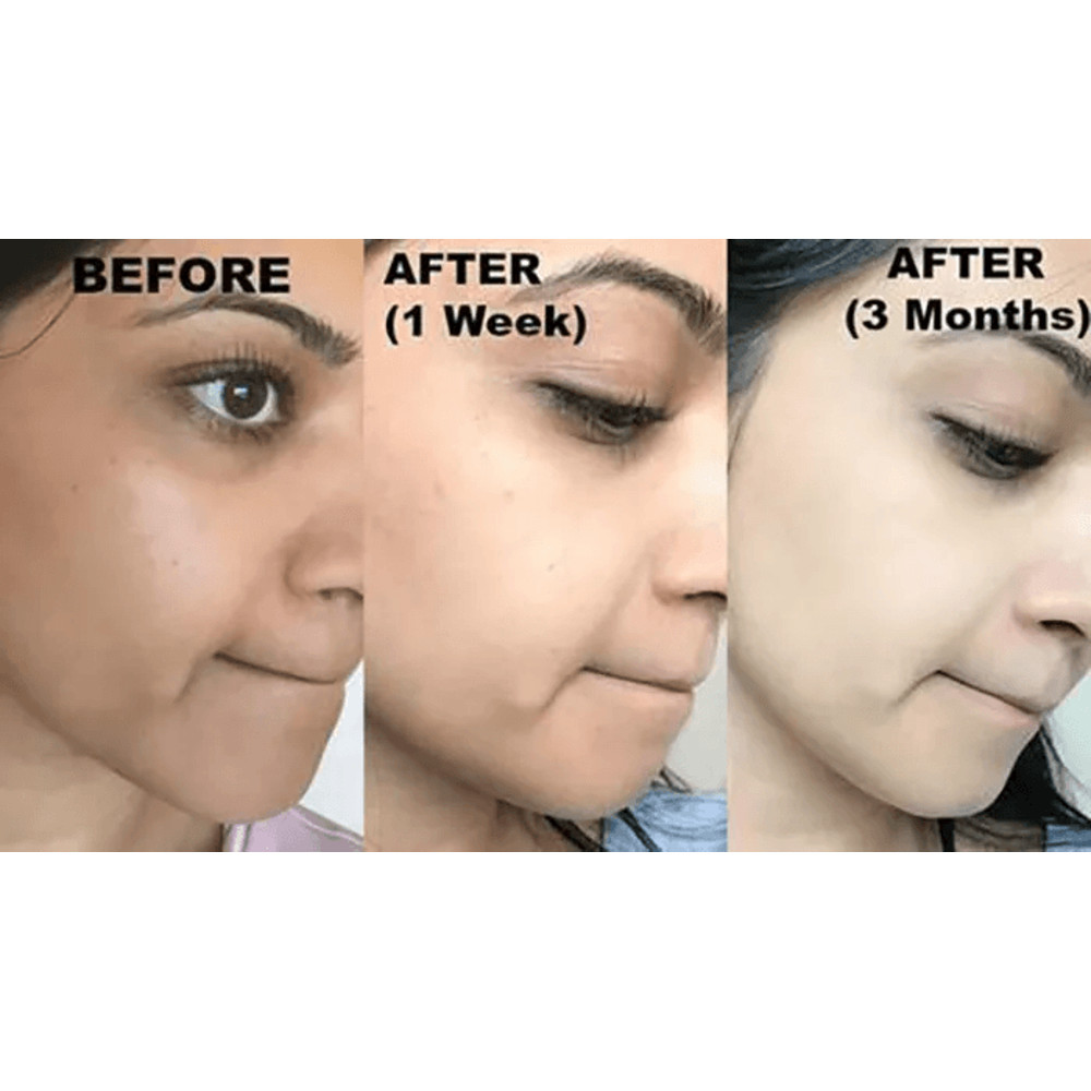 KOJIC ACID Skin Whitening Face Brightening Serum Dark Spot Remover With Alpha ArbutinVitamin C Mela 2