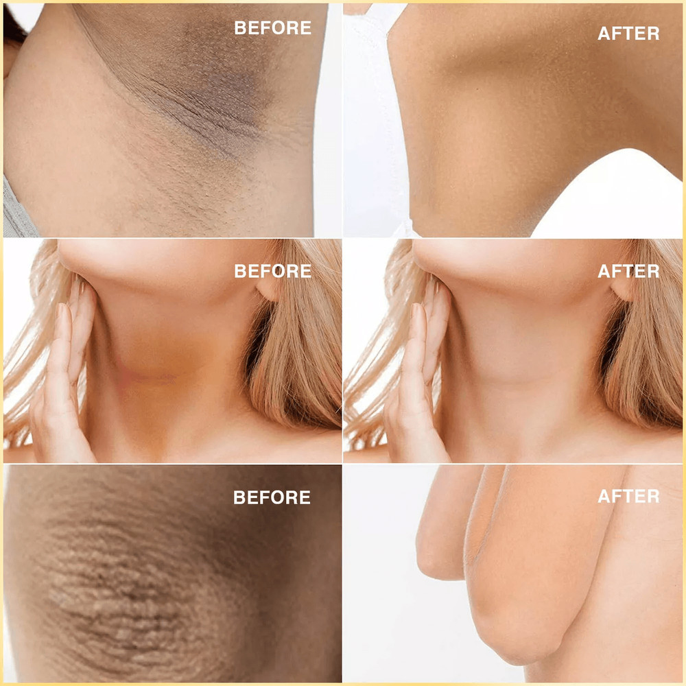 KOJIC ACID Skin Whitening Face Brightening Serum Dark Spot Remover With Alpha ArbutinVitamin C Mela 1