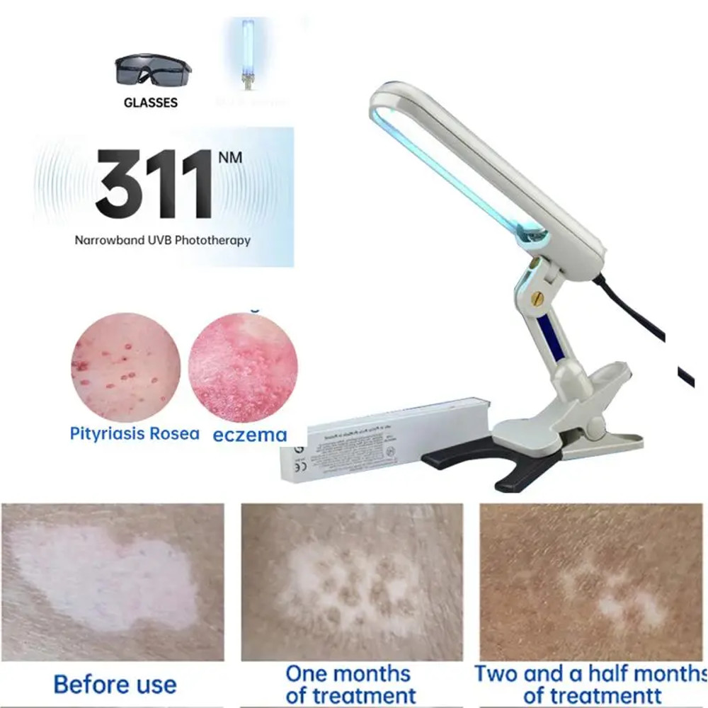 UV 311nm Ultraviolet Phototherapy Device Uses Philips Lamp UVB To Treat Vitiligo Psoriasis White Sp 2