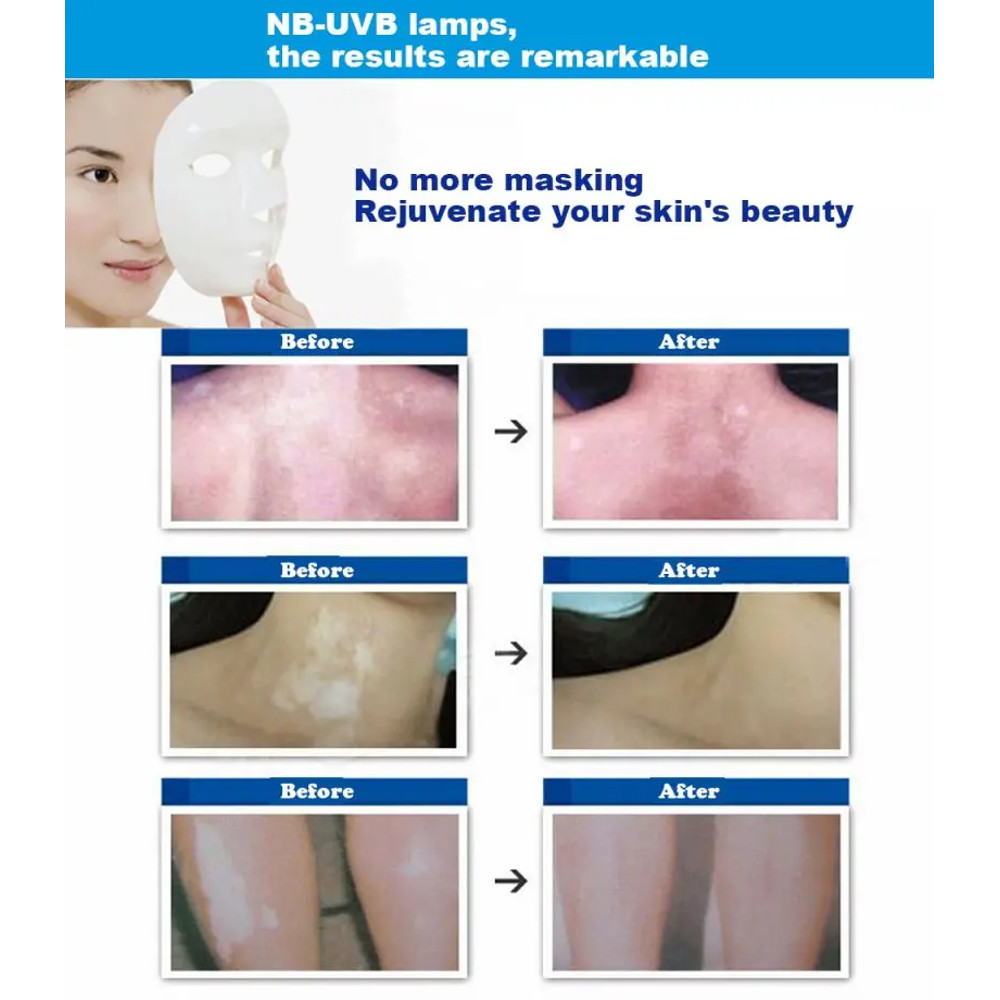 UV 311nm Ultraviolet Phototherapy Device Uses Philips Lamp UVB To Treat Vitiligo Psoriasis White Sp 3