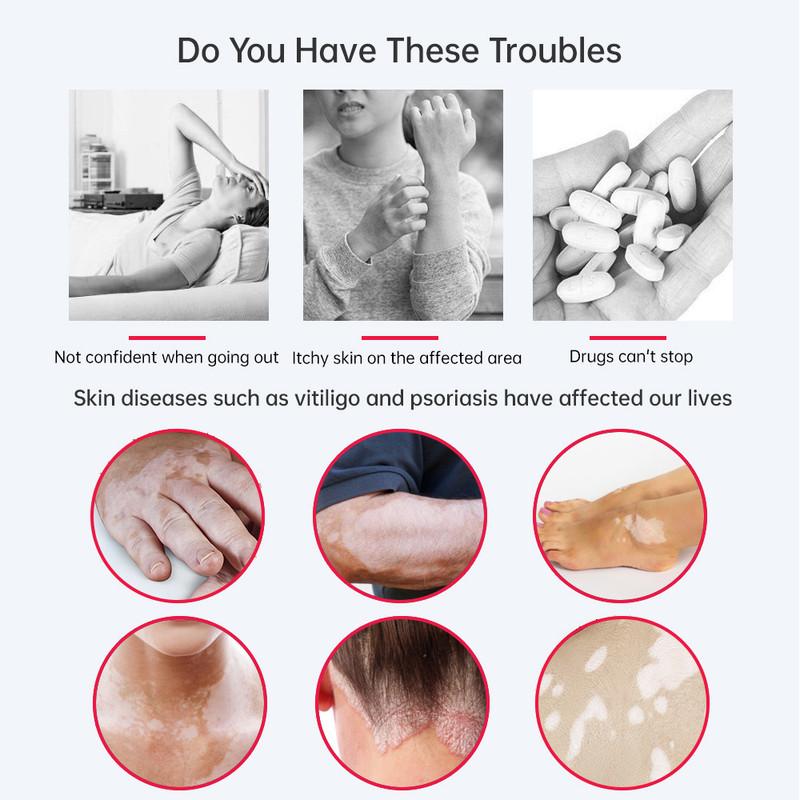 Ultraviolet Phototherapy Instrument use UVB Philips Lamp UV for Vitiligo, Psoriasis, White Spots Skin Disease