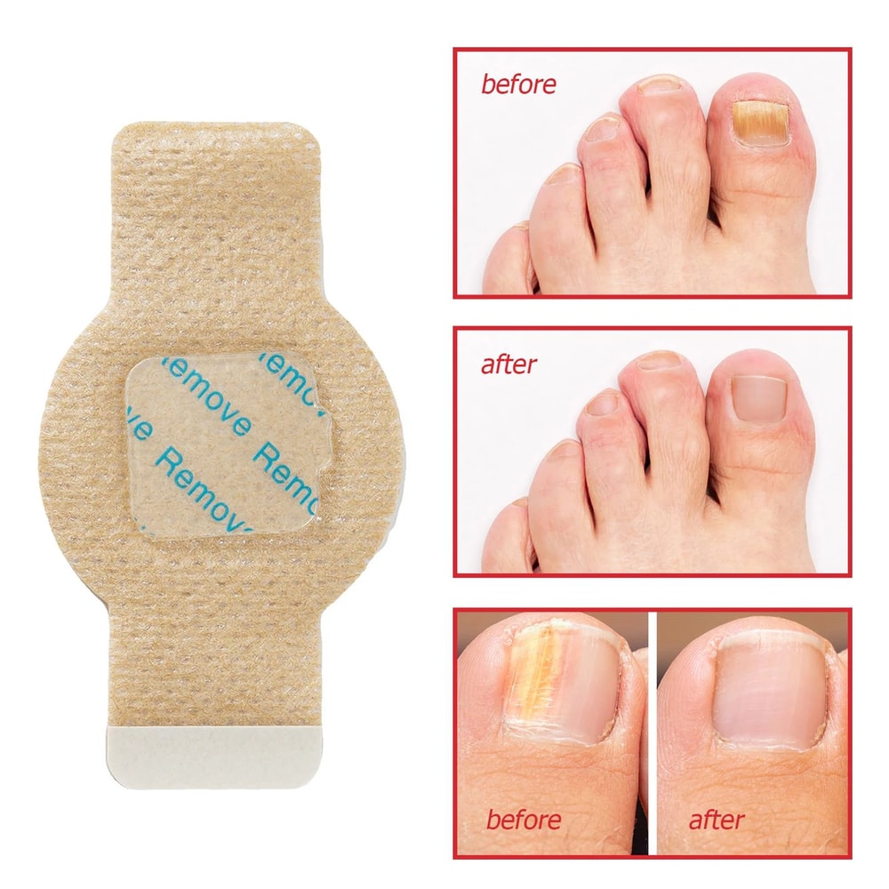 FastActing Toenail Fungus Treatment Patches For Nail Discoloration Brittle Peeling Breaking Thin N 3