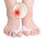 AlignEase Silicone Toe Corrector Hallux Valgus Separator 1 Pair 1