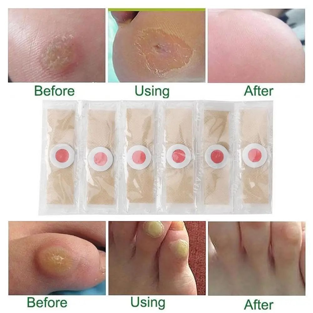 6 Pcs Foot Corn And Callus Protector Pads 2