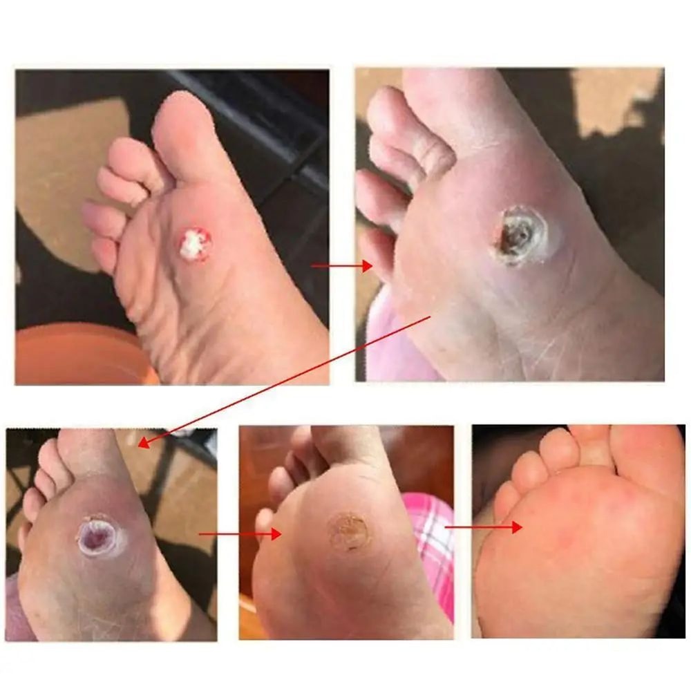 6 Pcs Foot Corn And Callus Protector Pads 4