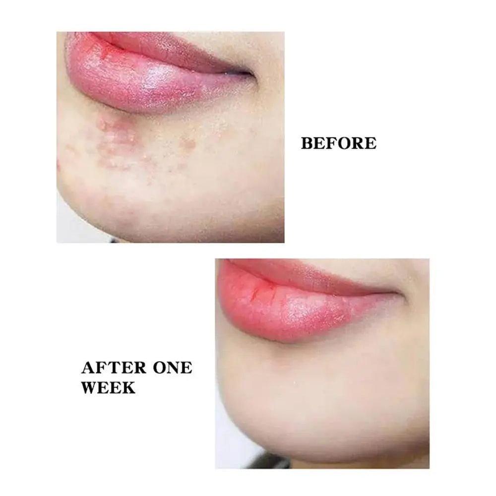 Star And Heart Acne Patch Stickers 13