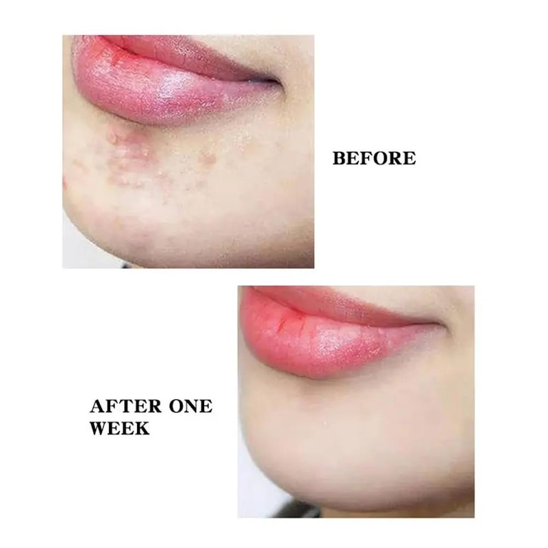 Star And Heart Acne Patch Stickers 13