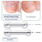 Precision Ingrown Toenail Correction Patch Set Professional Toe Brace Treatment Tool 1