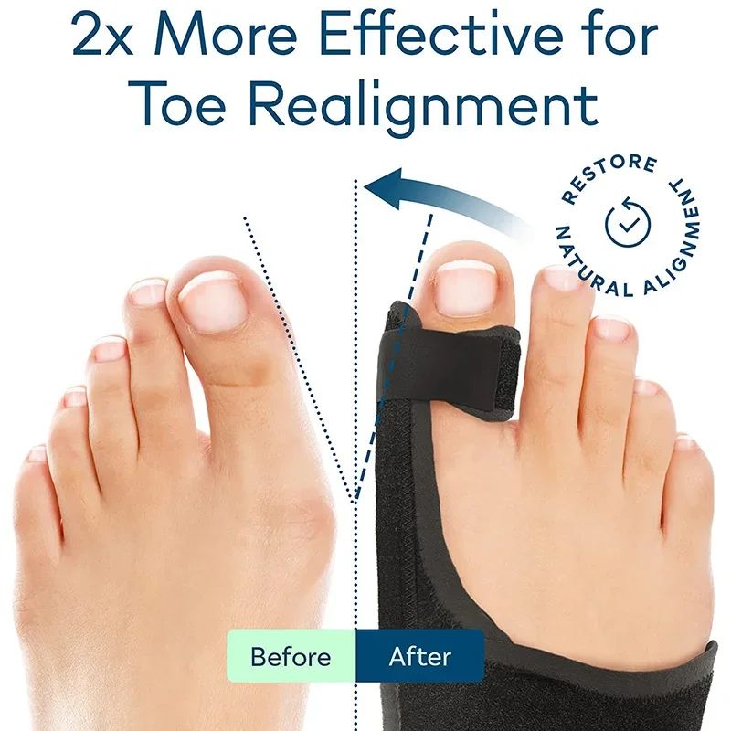 ErgoAlign Bunion Corrector Toe Separator Hallux Valgus Splint 1
