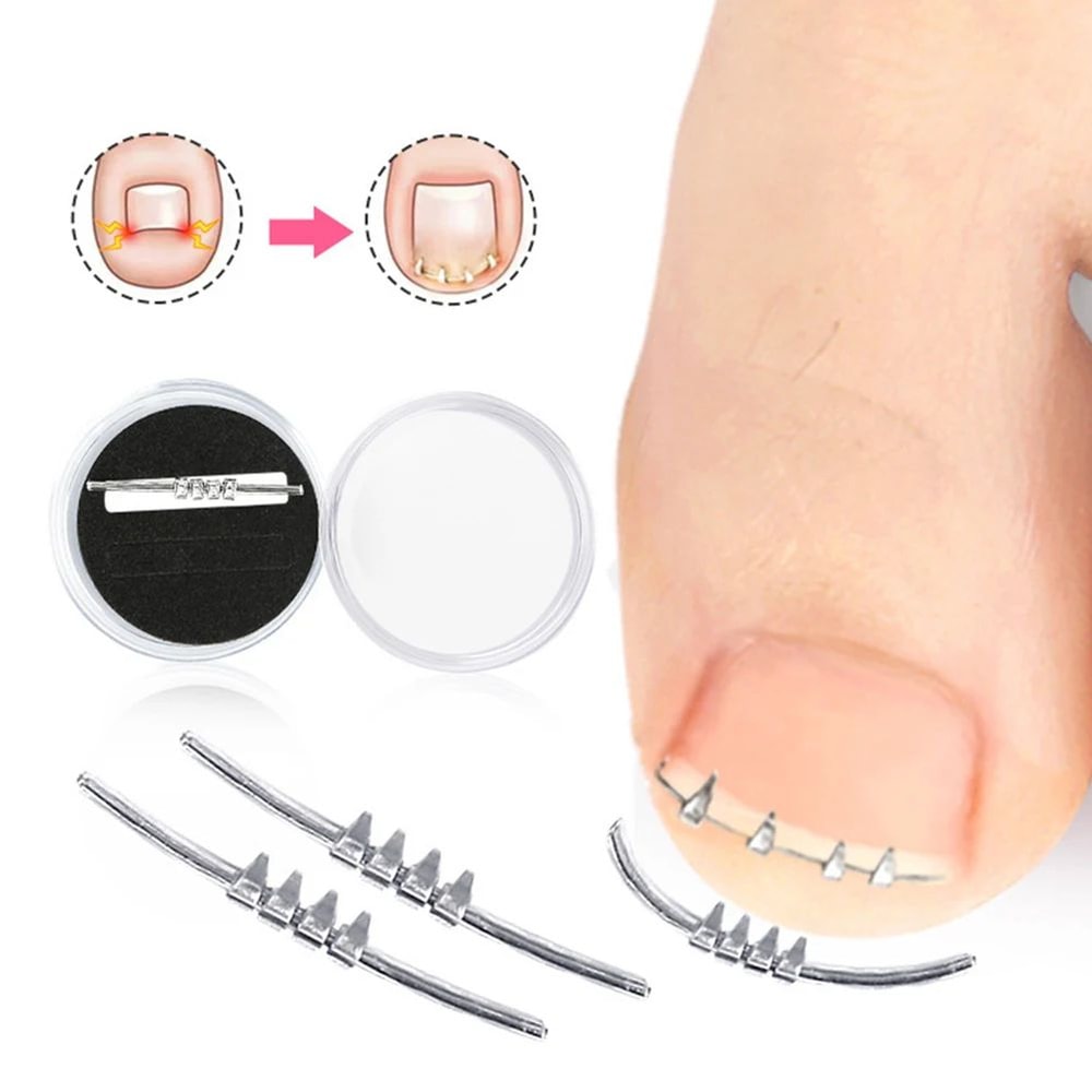 Pain Relief Ingrown Toenail Corrector Clamp Precision Curved Nail Correction Tool 0