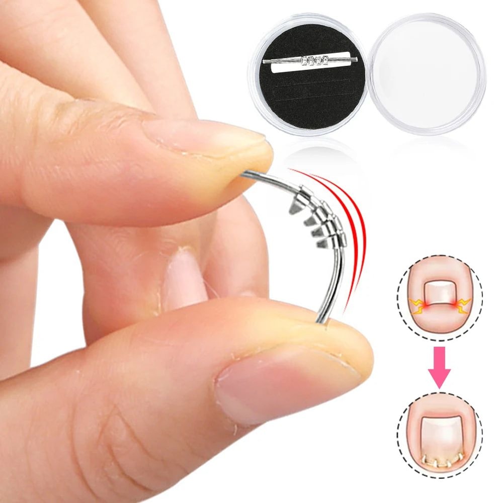 Pain Relief Ingrown Toenail Corrector Clamp Precision Curved Nail Correction Tool 1