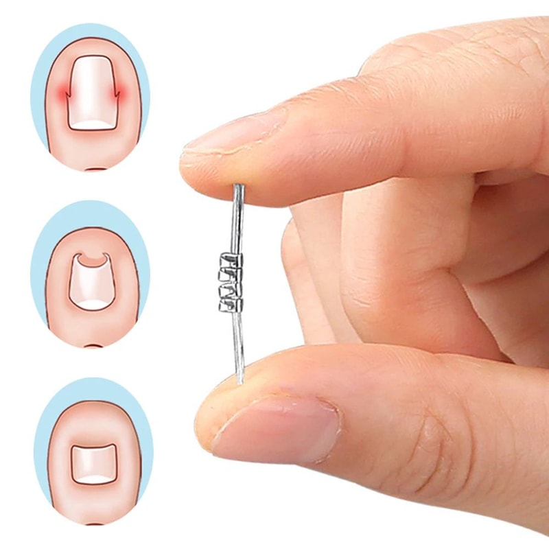 Pain Relief Ingrown Toenail Corrector Clamp Precision Curved Nail Correction Tool 2
