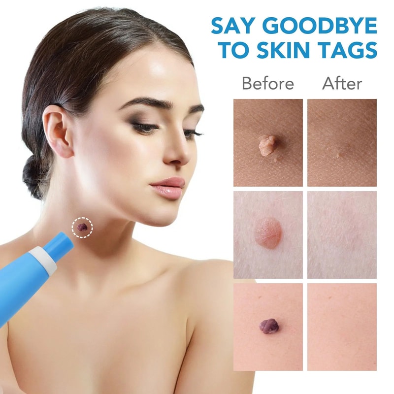 2in1 Precision Skin Tag Remover Pen Mole Removal Device For AtHome Skin Care 1