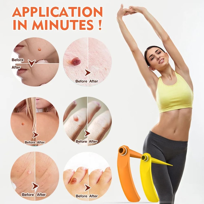 Precision 2in1 Skin Tag Remover Pen Facial Blemish Care Kit 1