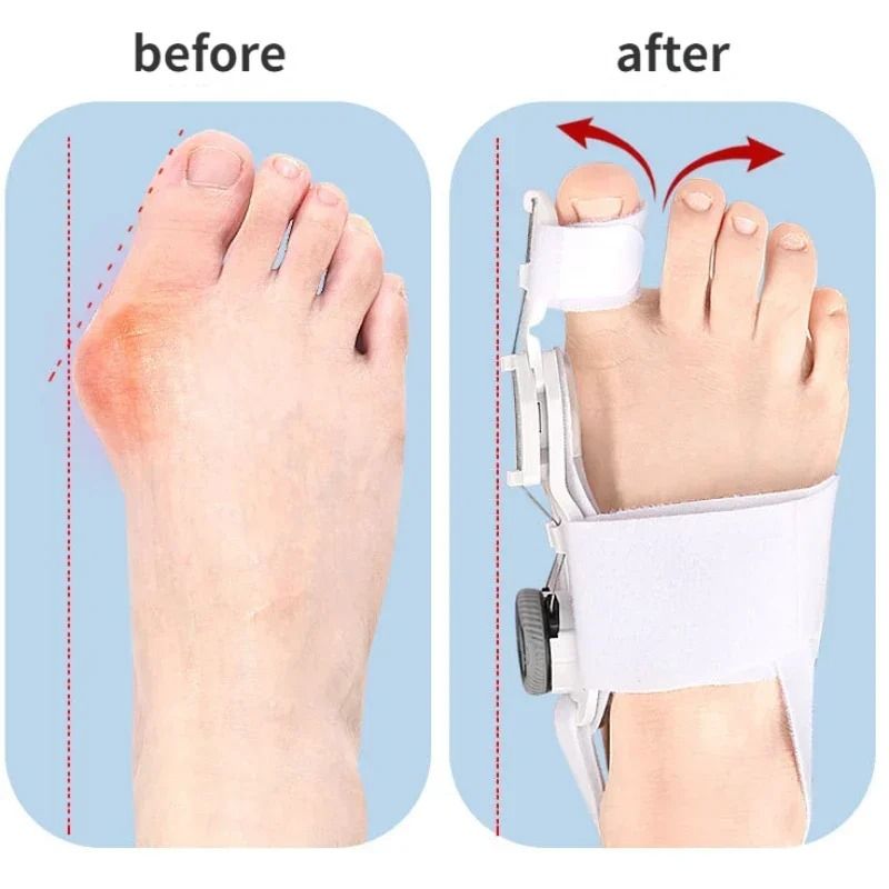 Bunion Corrector Hallux Valgus Brace Adjustable Toe Separator Toe Straightener 12