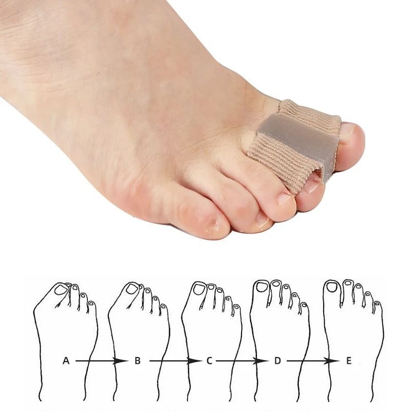 Silicone Toe Separator And Bunion Corrector Gel Toe Spacers For Shoes 1