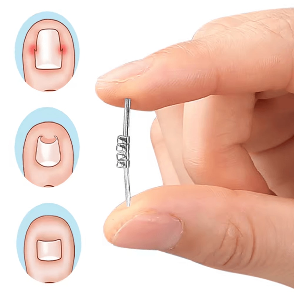 Professional Ingrown Toenail Corrector Tool Curved Clamp Pedicure Nail Straightening Kit 2