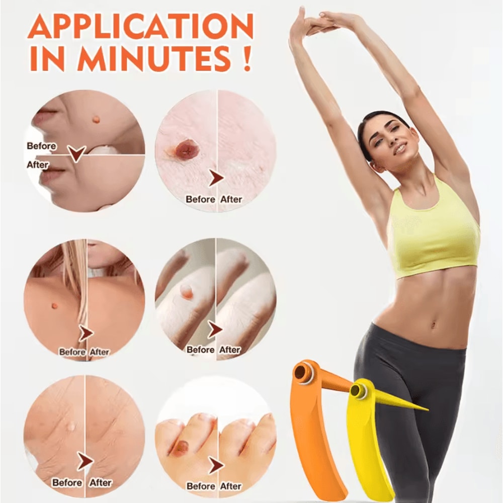 2in1 Skin Tag Wart Removal Pen Kit Precision Facial Care Tool With Cleansing Swabs 1