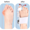 Bunion Corrector Brace With Rotatable Toe Separator And Adjustable Straightener 4