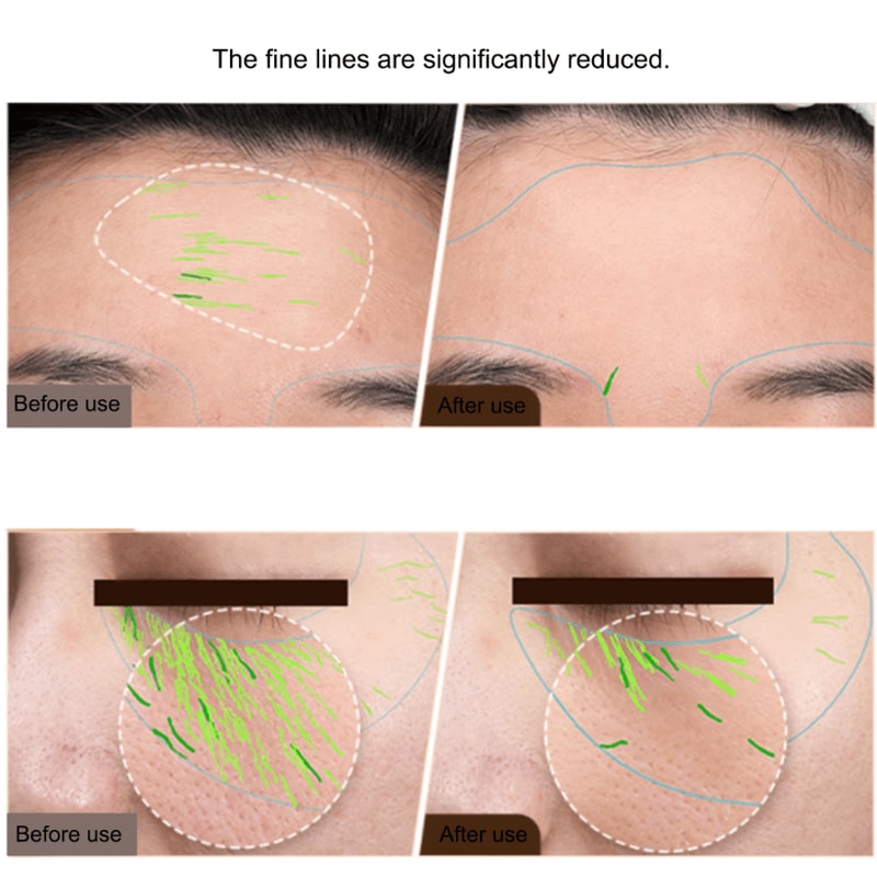 EMS Facial And Body Radio Frequency Machine Professional Home RF Skin Tightening And Face Lifting 1