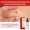 Ximonth Natural Wart Remover Liquid For Moles Skin Tags Dark Spots 20ml 4