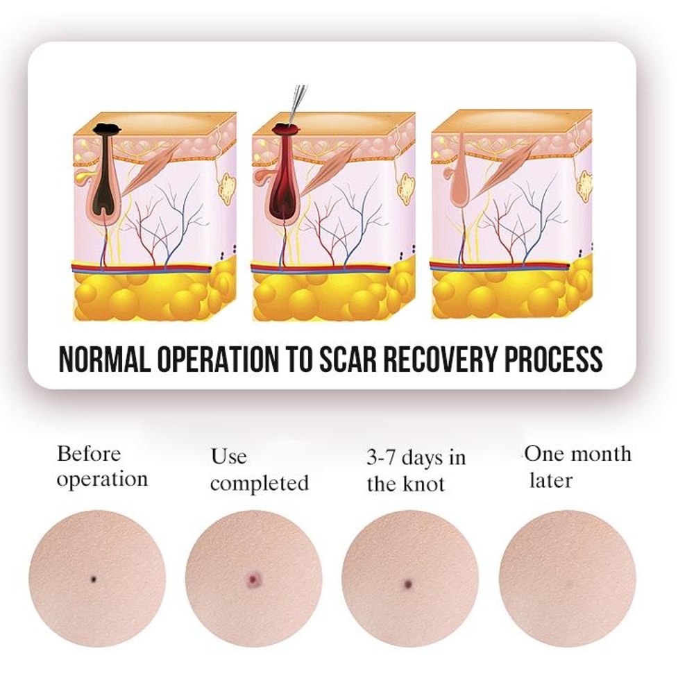 Precision Mole Removal Pen With 9 Levels LED Display Blue Light Care 2