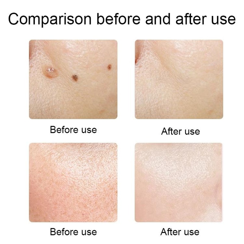 Precision Mole Removal Pen With 9 Levels LED Display Blue Light Care 7