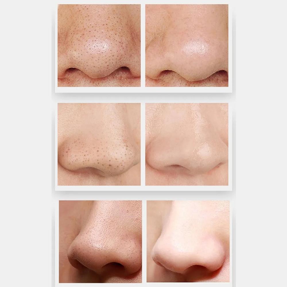 peed Electric Blackhead Remover Vacuum with LCD Display Facial Pore Cleaning Device