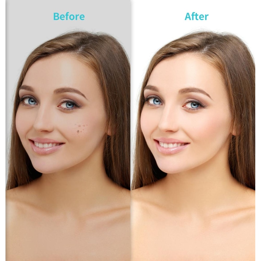 Professional Dark Spot Remover Pen with LED Screen & Adjustable Precision Levels
