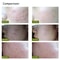 KSKIN Blue Light Acne Laser Pen Wrinkle Scar Removal Device For Clearer Smoother Skin 5