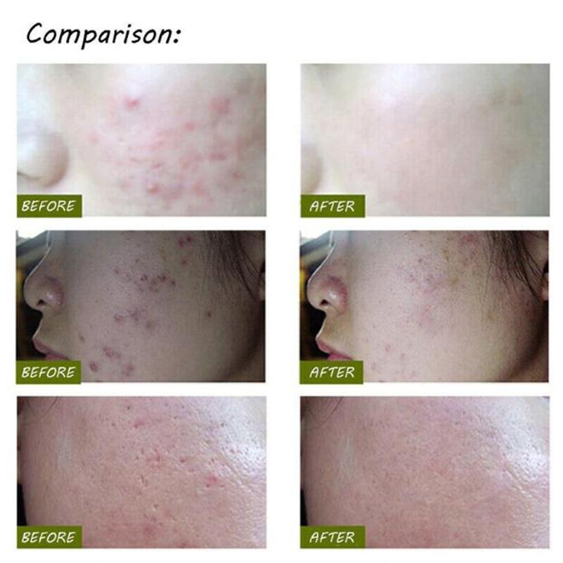 KSKIN Blue Light Acne Laser Pen Wrinkle Scar Removal Device For Clearer Smoother Skin 5