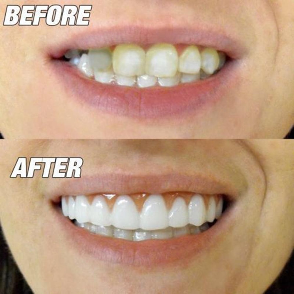 Comfort Fit Flex Silicone Veneers for Instant Smile Whitening