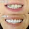 Comfort Fit Flex Silicone Veneers for Instant Smile Whitening