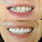 Comfort Fit Flex Silicone Veneers for Instant Smile Whitening
