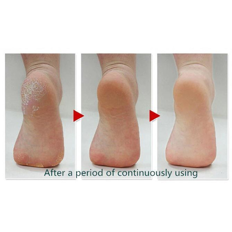highefficiency callus remover for quick results